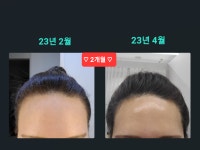 SUN 스칼프 크리닉