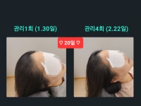 SUN 스칼프 크리닉