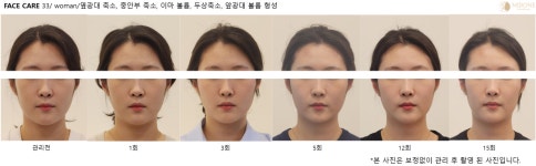 미본 얼굴윤곽관리 강남점