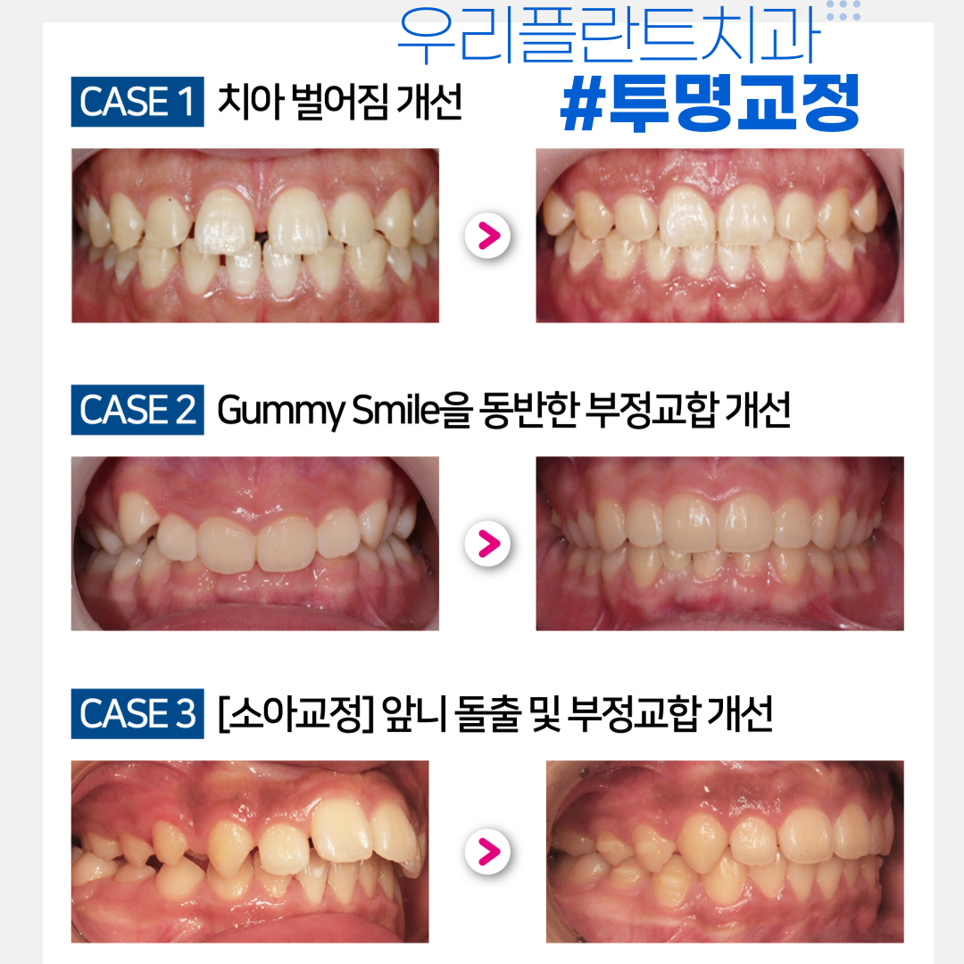 우리플란트치과의원 광고