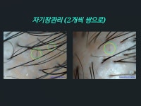 SUN 스칼프 크리닉