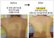 퀸즈스킨