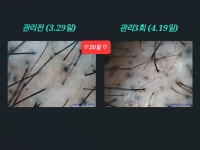 SUN 스칼프 크리닉