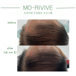 채움제이 가발 모발생장술 두피탈모관리