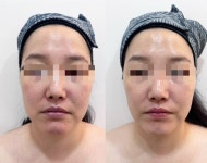 니쥬테라피