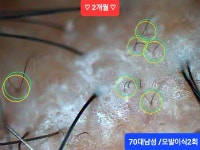 SUN 스칼프 크리닉