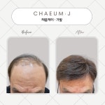 채움제이 가발 모발생장술 두피탈모관리