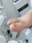 레푸스 진장점