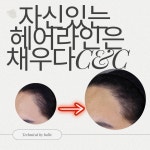 채우다아카데미 탈모커버&생장술&숱채움&눈썹커버&원형탈모