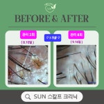 SUN 스칼프 크리닉