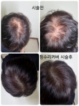 원포인트 콜드플라즈마 용산 | 원포인트 콜드플라즈마