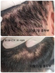 원포인트 콜드플라즈마 용산 | 원포인트 콜드플라즈마