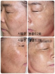 원포인트 콜드플라즈마