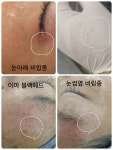 원포인트 콜드플라즈마 용산 | 원포인트 콜드플라즈마