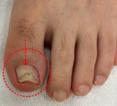 모모뷰티앤발톱전문가내성발톱발톱무좀전문 | 내성발톱 발톱무좀 관리 김수정뷰티