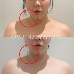 이플에스테틱