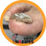 레푸스 용산역점 내성발톱 무좀발톱 발각질 문제성발