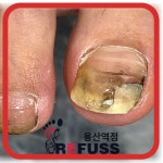 레푸스 용산역점 내성발톱 무좀발톱 발각질 문제성발