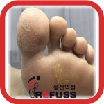 레푸스 용산역점 내성발톱 무좀발톱 발각질 문제성발