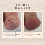 레푸스 화서역점 풋케어 발톱 발각질 문제성 발관리전문점