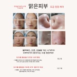인셀덤맑음 | 맑은피부에스테틱