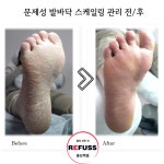 레푸스 용산역점 내성발톱 무좀발톱 발각질 문제성발