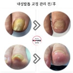 레푸스 용산역점 내성발톱 무좀발톱 발각질 문제성발