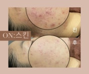온스킨