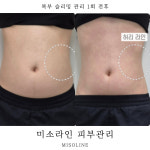미소라인 피부관리