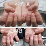 LCN네일니케_발톱교정,문제성손/발관리,조갑박리
