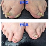 본네일 동성제약 풀리메디