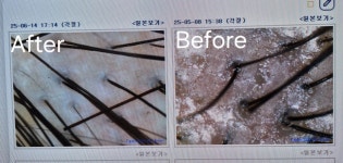 닥터스칼프봄