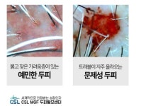 씨에스엘엠지에프두피탈모센타성성 | CSLMGF두피탈모센타 신불당점