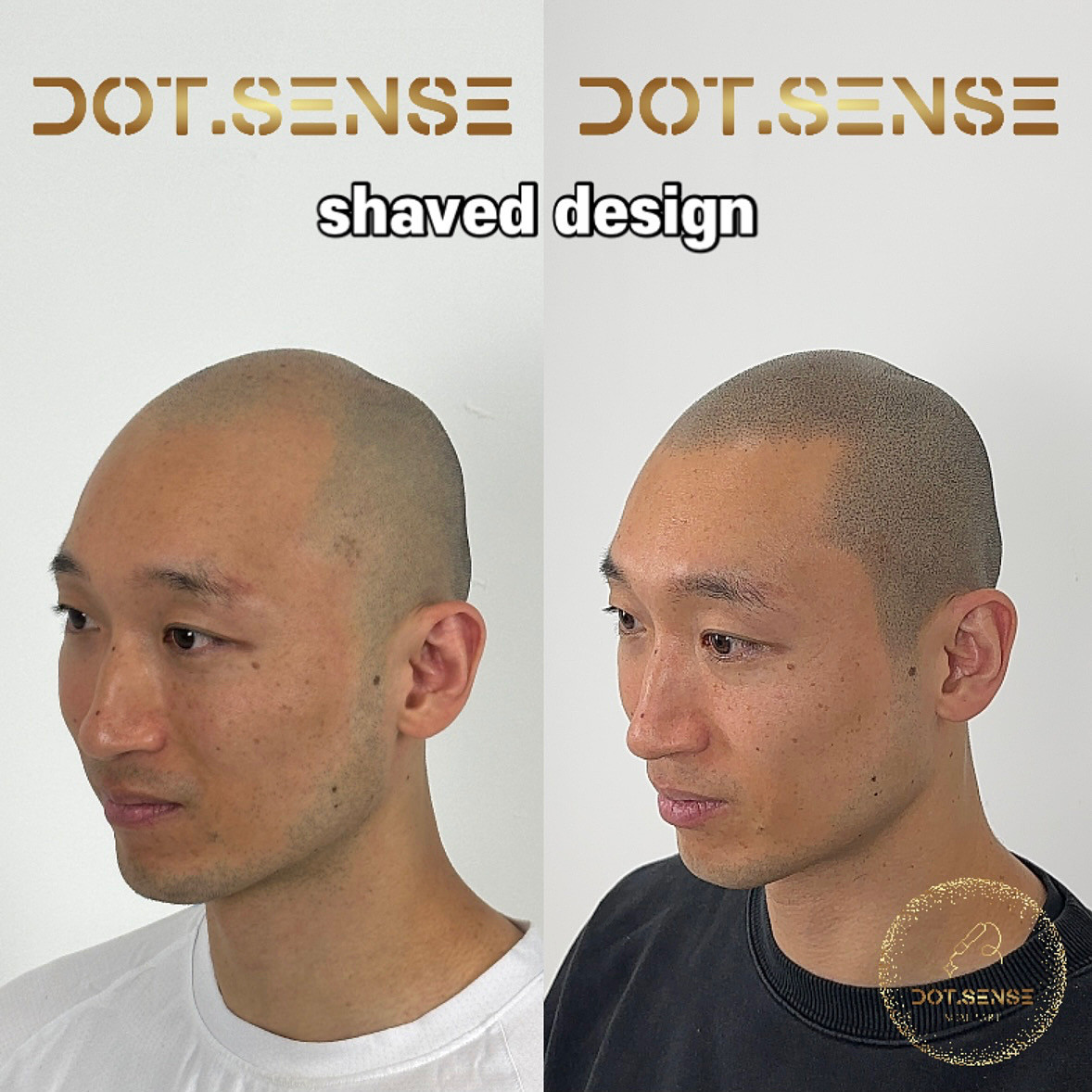 노원구 노원탈모