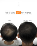 생명나무두피프렌즈 | 두피움SMP