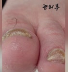 본네일 동성제약 풀리메디