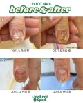 아이풋네일 문제성발톱 케어
