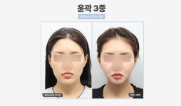 비티성형외과의원 강남