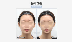 비티성형외과의원 강남