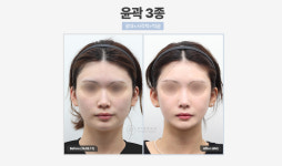 비티성형외과의원 강남