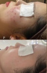 피브이에스테틱