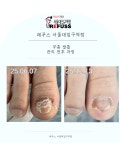 레푸스 발각질 내성발톱