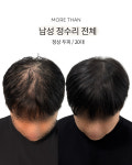 대구두피문신 모어댄smp