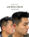 대구두피문신 모어댄smp