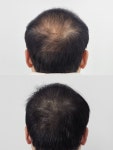 스칼프디자인센터 원주 두피문신