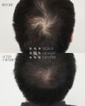 스칼프디자인센터