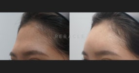 이마 필러-Reracle Clinic
