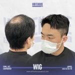 비포 &에프터-대구가발화이트하우스서울대구
