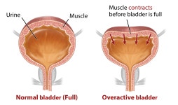 아트라