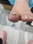 레푸스 가락점